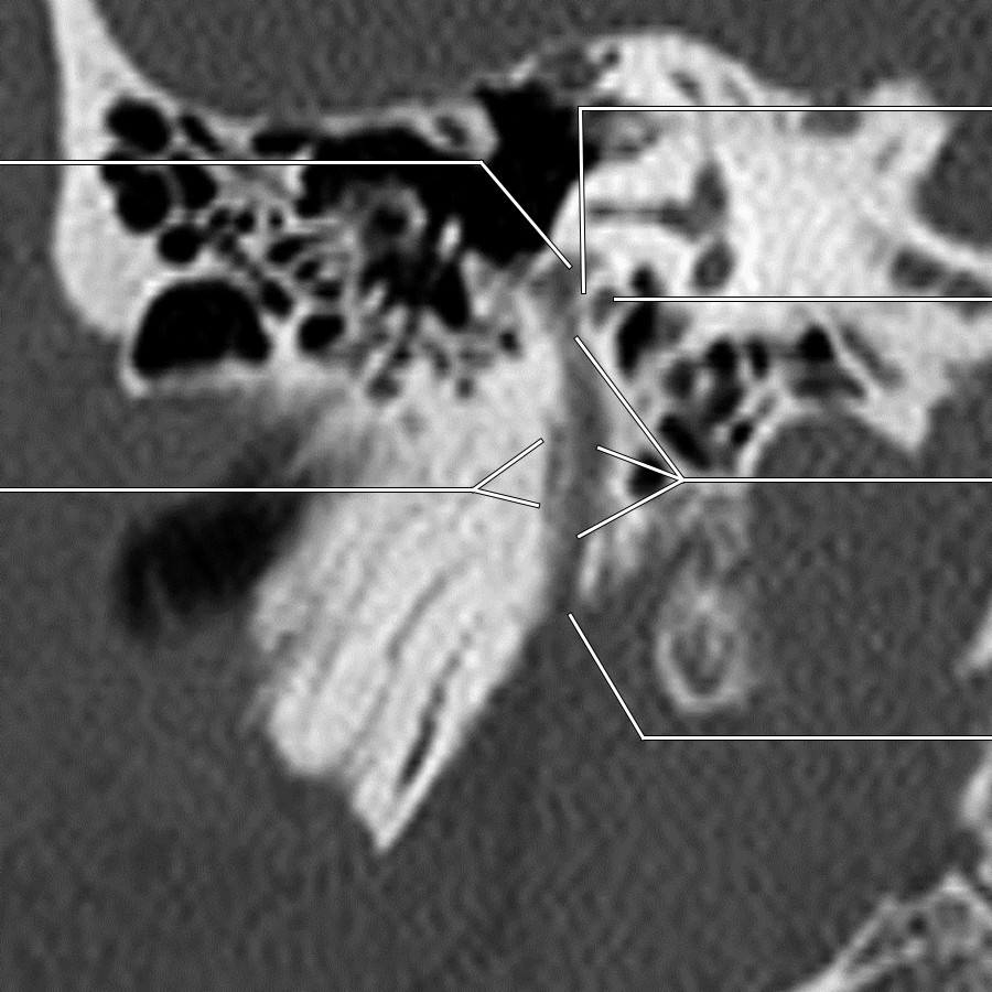 CT shows the posterior genu & descending mastoid segment of the facial nerve with branches.