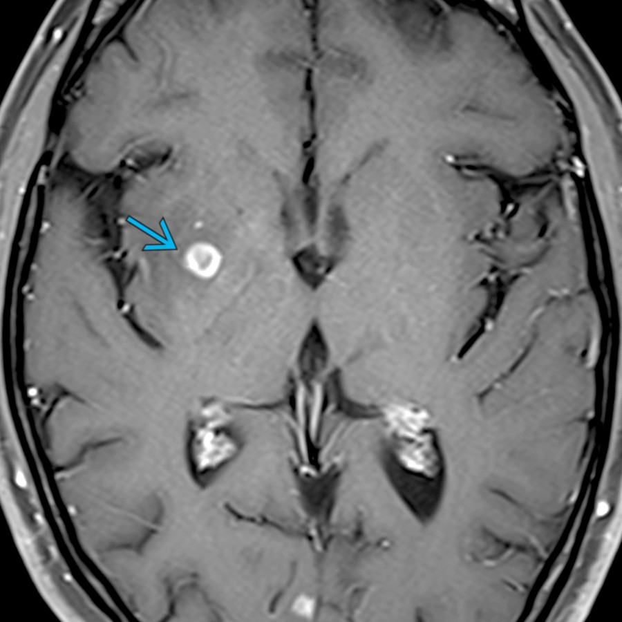 Axial T1 C+ MR shows an enhancing right BG mass  in an AIDS patient. Post therapy, enhancing lesions typically calcify. The BG is the most common location for toxoplasmosis followed by the thalamus, then the cerebral hemispheres.