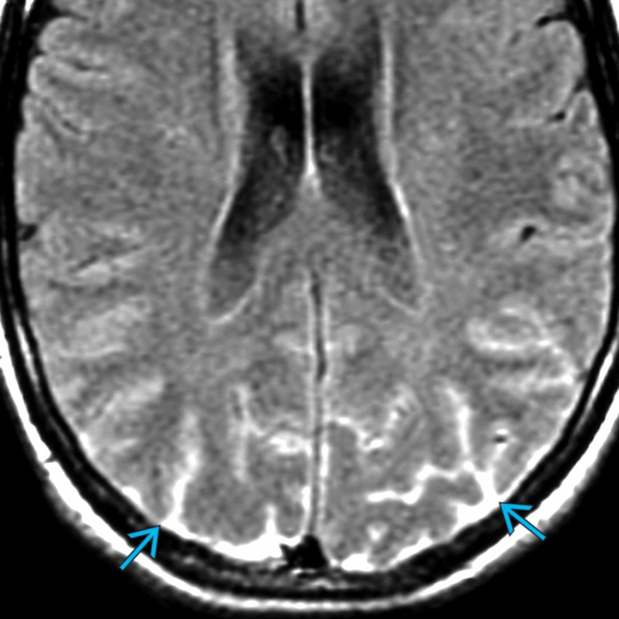 Axial FLAIR MR shows artifactual hyperintensity in the occipital sulci  secondary to incomplete CSF suppression. A repeat scan (not shown) was normal. Sulcal hyperintensity on FLAIR is nonspecific and can be caused by pia-subarachnoid metastases, blood, protein (meningitis), high oxygen content, retained contrast (renal failure), and artifact (as in this case).