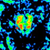 Anisotropy map in which high anisotropy values are seen in red shows diminished anisotropy in the left side of the pons despite normal T2WI in the same patient.