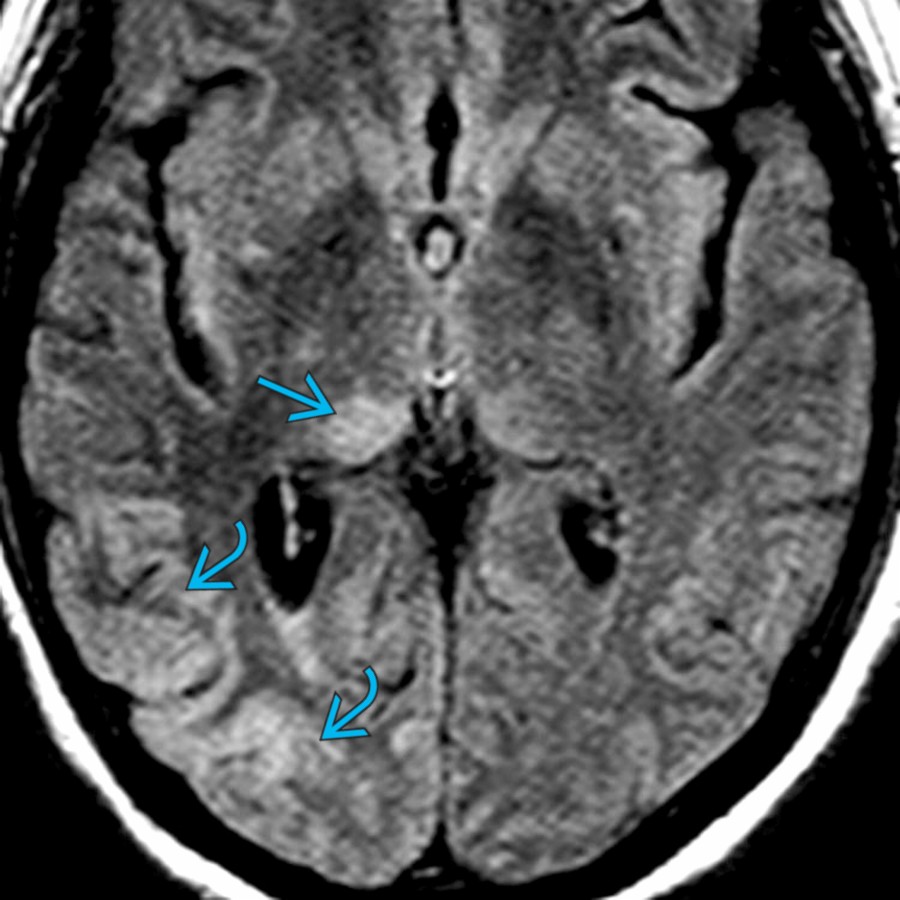Axial FLAIR MR in a patient with SE shows right temporal and parietal cortex/subcortical hyperintensity . Note high signal in the pulvinar nucleus of right thalamus .