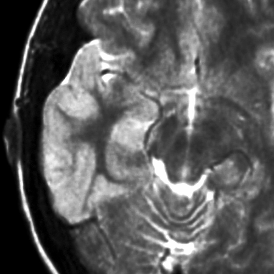 Axial T2WI MR shows hyperintensity in the right temporal cortex with mild gyral expansion and sulcal effacement in this 20 year old with SE and temporal lobe epilepsy. Repeat imaging was normal.