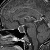 Sagittal T1 C+ MR shows a sellar and suprasellar Rathke cleft cyst with a classic claw sign of compressed pituitary gland  surrounding the nonenhancing mass. Rathke cleft cyst was confirmed at surgery.