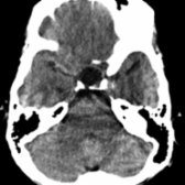 Axial NECT shows a hypodense, CSF-like intra- and suprasellar mass . Rathke cleft cyst was found at surgery.