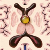 Axial graphic shows a classic colloid cyst (CC) at the foramen of Monro causing mild/moderate obstructive hydrocephalus. Note that the fornices and choroid plexus are elevated and stretched over the cyst .
