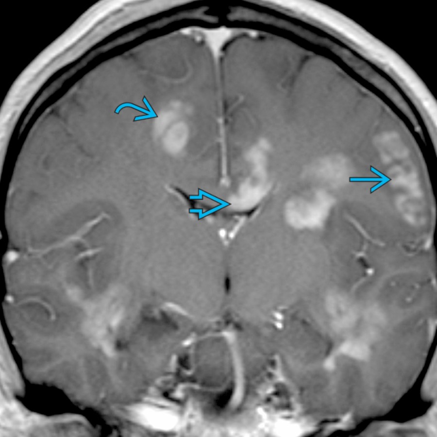 Coronal T1 C+ MR shows multiple patchy/confluent, avidly enhancing lesions involving gray matter , WM , and along periventricular region , findings consistent with ADEM. Patient had upper respiratory tract infection 1 week before neurologic symptom onset.