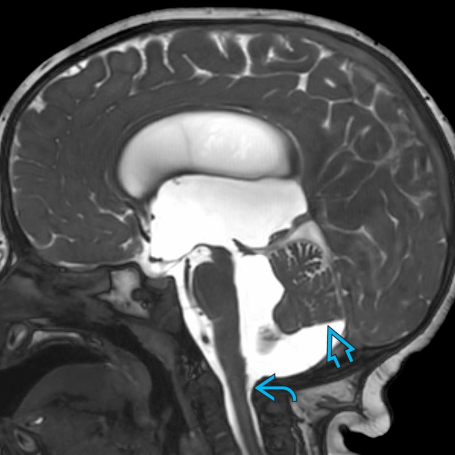 This 3-month-old with hydrocephalus has a Blake pouch cyst obstructing outflow of CSF from the 4th ventricle. Note the membrane across the posterior foramen magnum  and the uplifting of the vermis .