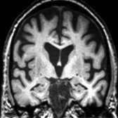 Coronal T1WI MR in a patient with DLB shows prominent frontal lobe volume loss with relative sparing of hippocampal volume. (Courtesy M.J. Firbank, MD & J.T. O'Brien, MD.)