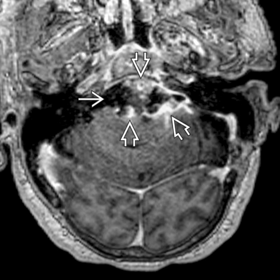 Axial T1 C+ MR shows nodular soft tissue enhancement  along the margins of a cystic prepontine and left CPA epidermoid cyst , due to a rare complication: Malignant degeneration into squamous cell carcinoma.