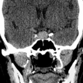 Coronal NECT in a patient with a headache shows a hyperdense, intrasellar mass with minimal suprasellar extension . Rathke cleft cysts are most commonly hypodense on CT. Note the lack of calcification, which helps distinguish RCC from craniopharyngiomas, which are typically calcified (90%).