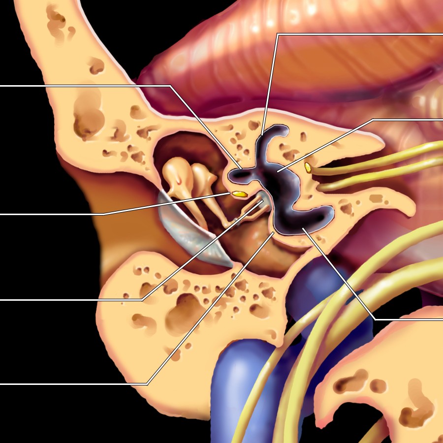 Coronal graphic shows craniocaudal orientation of LSCC, facial nerve canal (tympanic segment), oval window, & cochlear promontory, a very useful anatomic landmark for evaluating a coronal temporal bone CT. Superior & LSCCs, vestibule, & basal turn of cochlea together form a goose/duck-like appearance on coronal images.