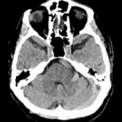 Axial CT shows fusiform dilatation and tortuosity of the basilar artery  in an octogenarian related to dolichoectasia. Fusiform dolichoectasia is a common finding in the vertebrobasilar arteries in older patients.