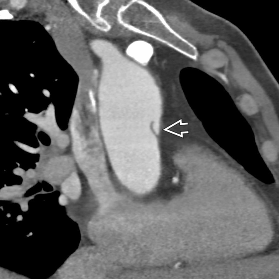 Corresponding oblique sagittal CECT in the same patient shows a focal tissue flap consistent with an undermined edge of a LIT . (Courtesy S. Kligerman, MD.)
