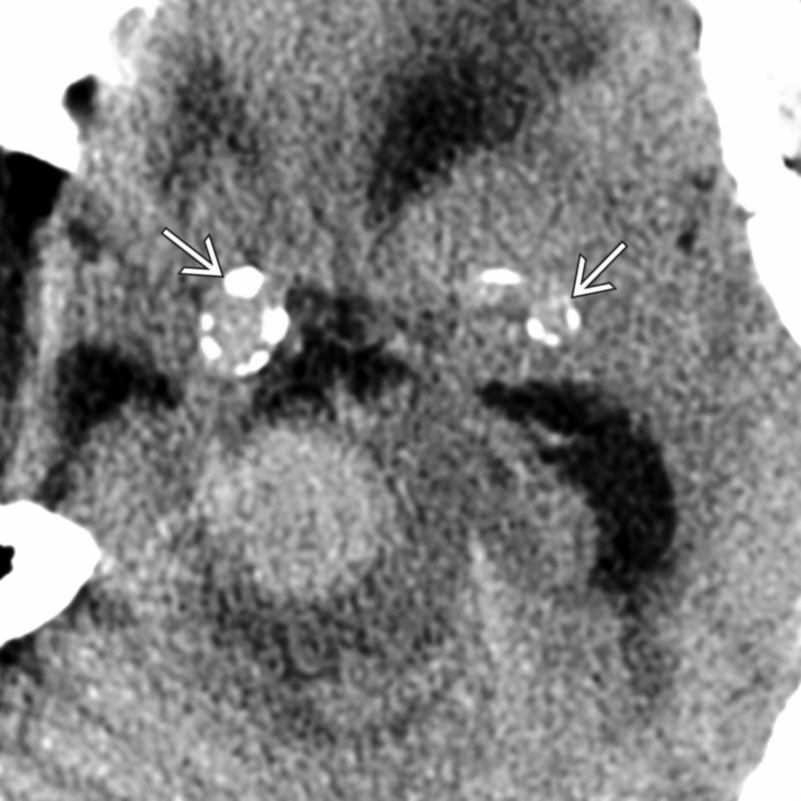 Axial NECT shows intracranial atherosclerotic disease with extensive Ca⁺⁺ in internal carotid & middle cerebral arteries , which mimics BG Ca⁺⁺. Posterior fossa aneurysm is partially visible.