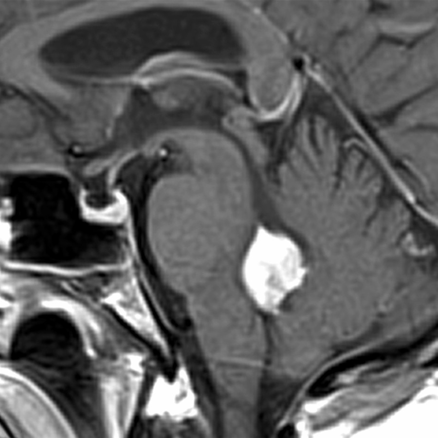 Sagittal T1WI C+ MR in a 52-year-old woman with episodic headaches, nausea, and vomiting shows an intensely enhancing 4th ventricle mass. This proved to be choroid plexus papilloma.