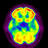Axial FDG PET in a patient with AD shows decreased glucose metabolism in both medial temporal lobes . Note the preserved glucose metabolism in the cerebellum and frontal lobes.