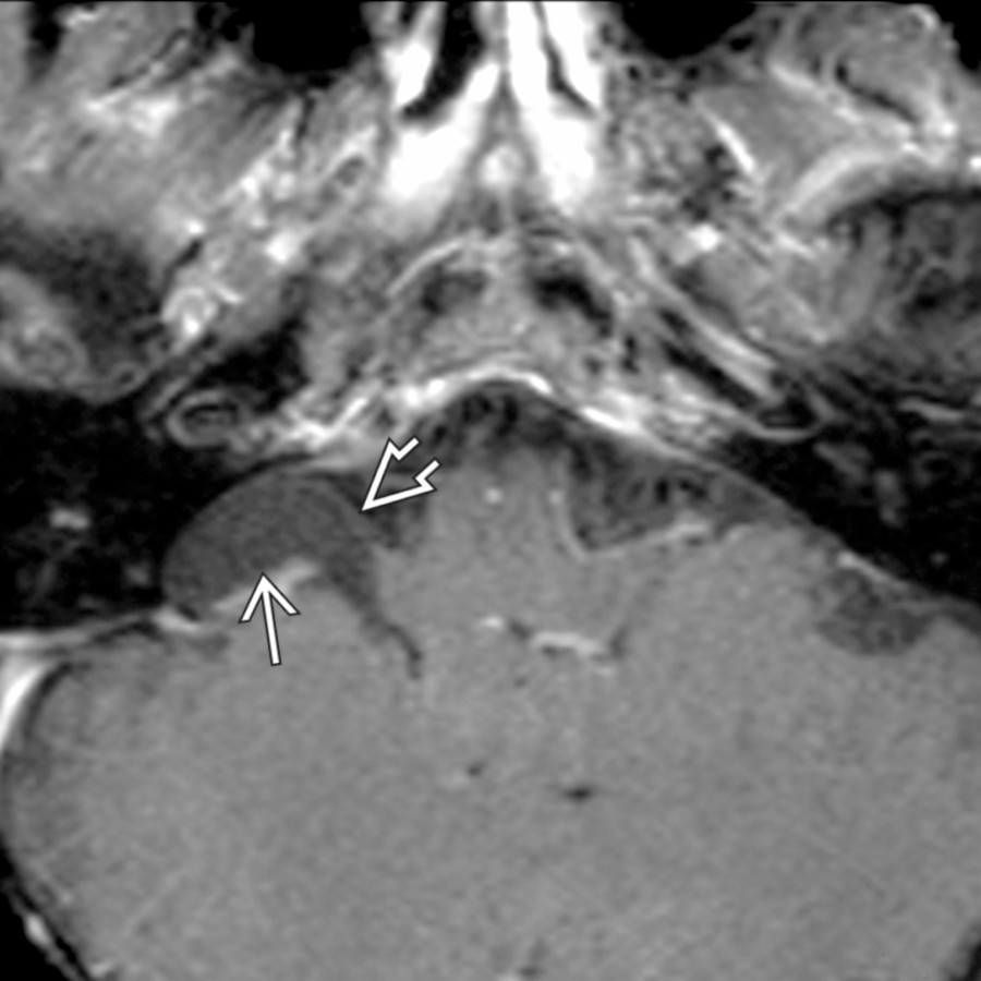 Axial T1 C+ FS MR demonstrates a right cerebellopontine angle (CPA) cistern arachnoid cyst  displacing the proximal facial and vestibulocochlear nerves anteriorly .
