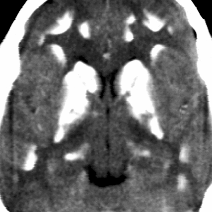Axial NECT shows a variant CT appearance of FD with extensive Ca⁺⁺ present in the BG, cerebral WM, & at the subcortical gray matter-WM junctions.