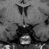 Coronal T1WI MR depicts the ectopic posterior pituitary gland location at the median eminence . A pituitary stalk is not visualized below the ectopic posterior pituitary. The septum pellucidum is present, and the optic tracts  are of normal size.