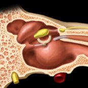 Graphic of medial wall of the right ear (anterior is to the right) demonstrates loss of bone covering midtympanic segment of the facial nerve canal  with associated mild enlargement and prolapse of tympanic facial nerve into oval window niche.