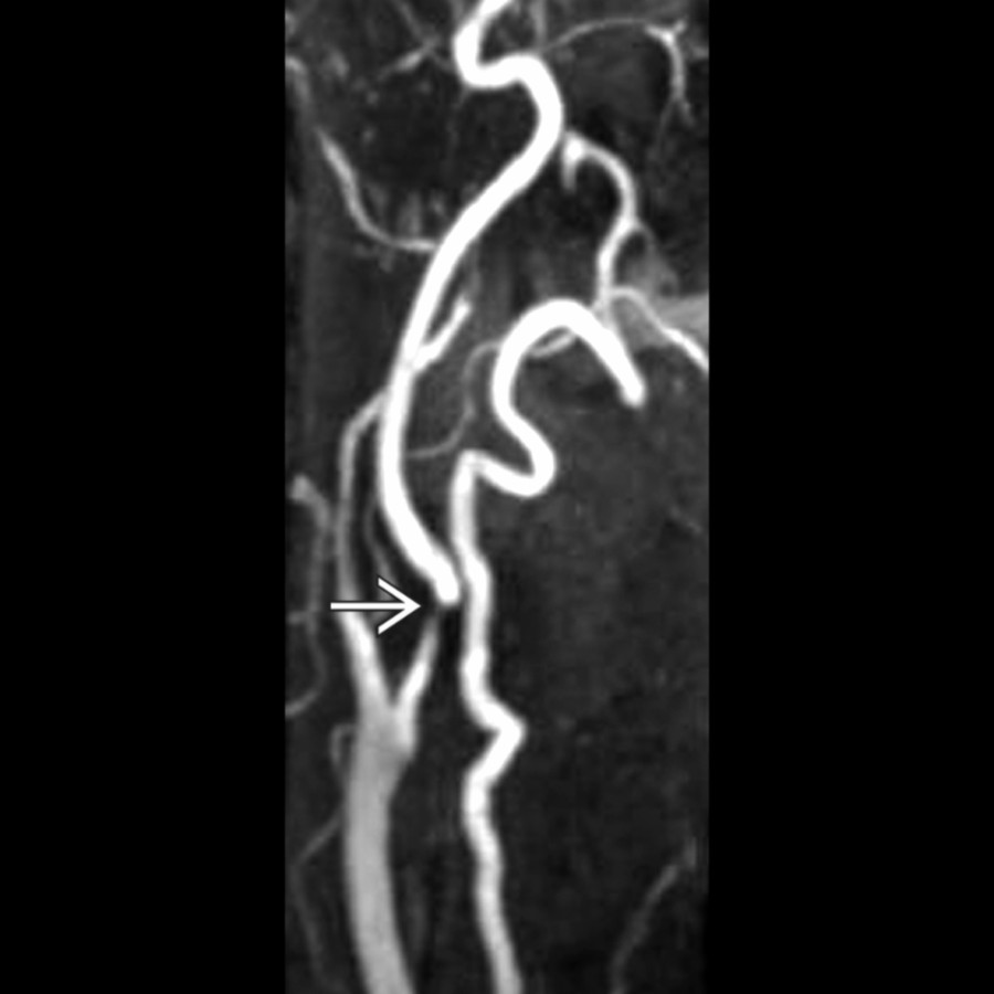 Sagittal MRA shows a flow gap in the ICA . MRA overestimates stenosis and occlusions; therefore, this must be confirmed with another vascular imaging modality to avoid misinterpretation.