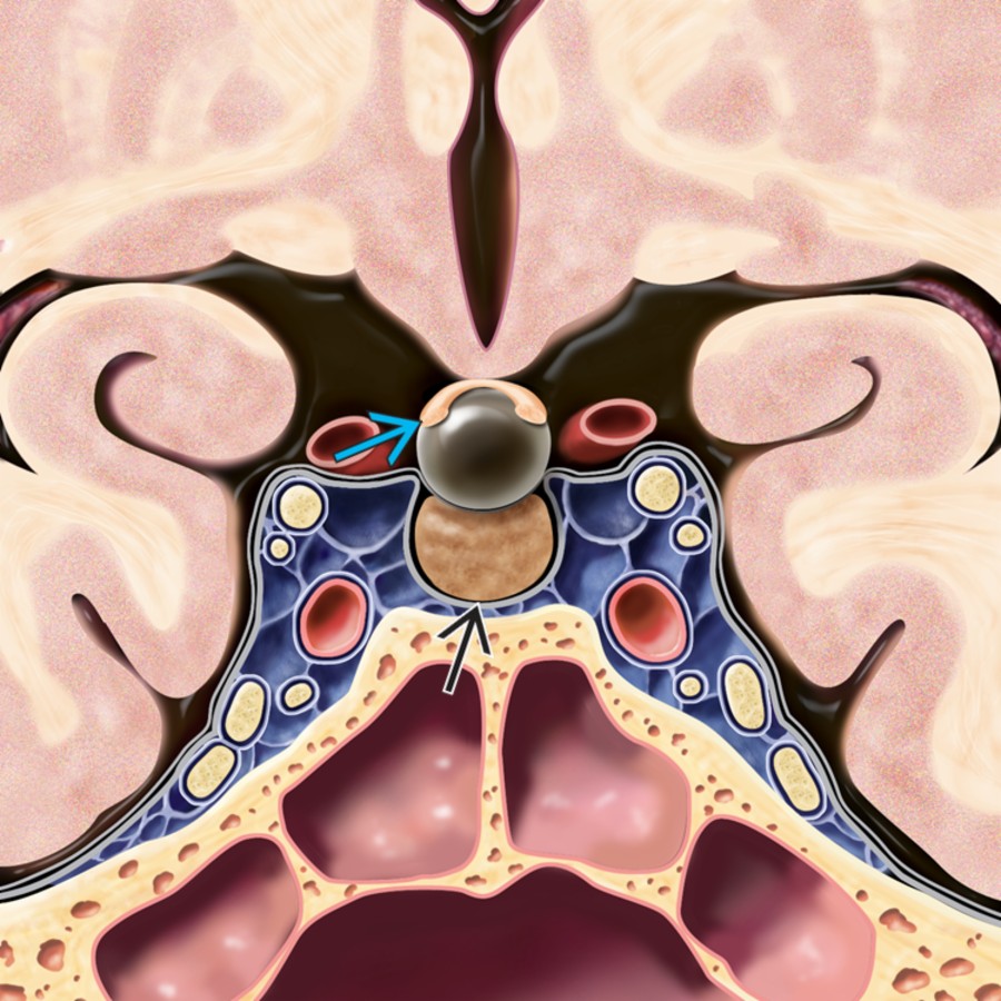 Coronal graphic shows a typical suprasellar Rathke cleft cyst interposed between the pituitary gland  and the optic chiasm .  The majority of Rathke cleft cysts are both sellar and suprasellar.