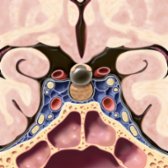 Coronal graphic shows a typical suprasellar Rathke cleft cyst interposed between the pituitary gland  and the optic chiasm .  The majority of Rathke cleft cysts are both sellar and suprasellar.