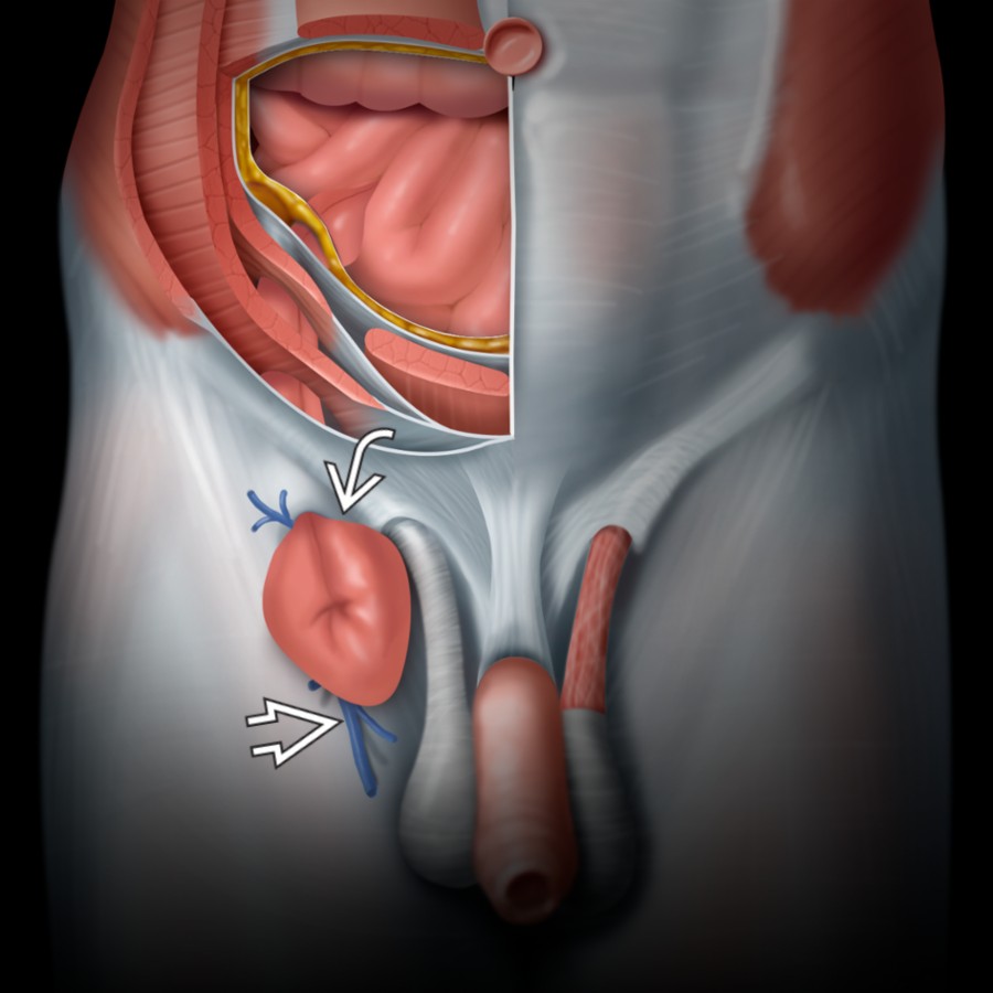 Graphic of a femoral hernia demonstrates a characteristic "knuckle" of small bowel  closely associated with the femoral vein . Femoral hernias are usually found medial to the femoral vessels with frequent compression of the femoral vein.