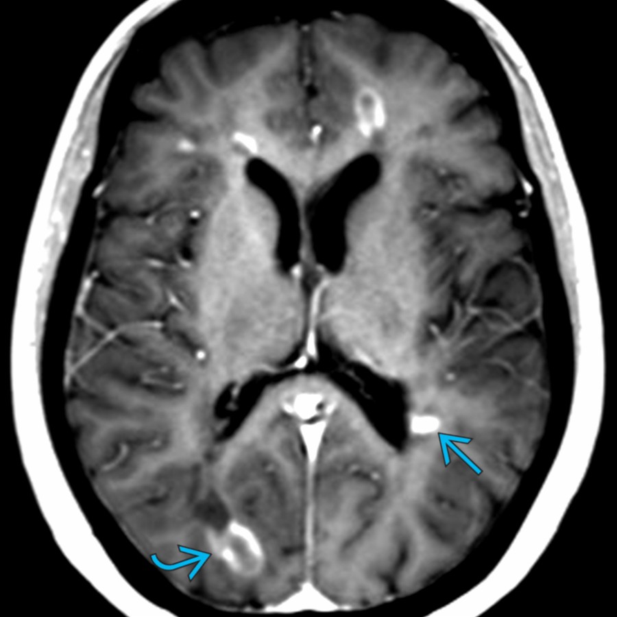 Axial T1 C+ MR shows several periventricular  and juxtacortical  enhancing lesions in a patient with relapsing/remitting multiple sclerosis. Note no associated mass effect.