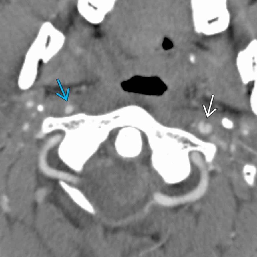 Axial CTA in the same patient with multiple infarcts shows vessel wall irregularity & an intimal flap in the left internal carotid artery (ICA) , consistent with dissection. The right ICA  is small & showed areas of irregularity on other images (not shown). The findings are consistent with bilateral ICA dissections.