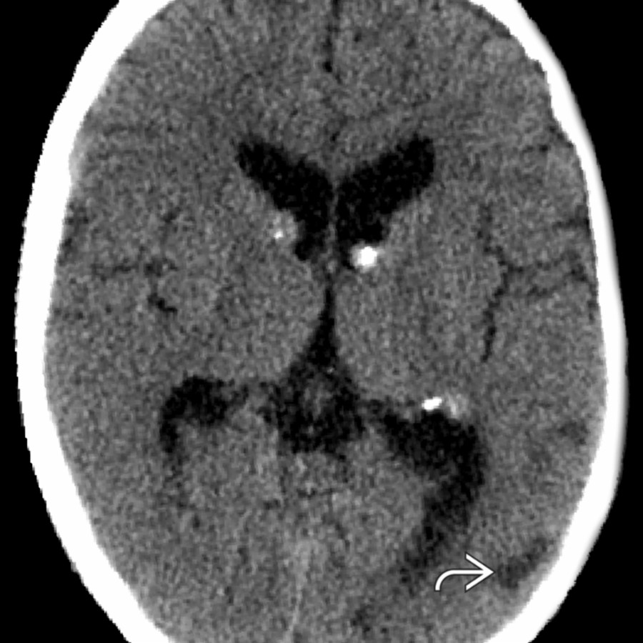 Axial NECT shows calcified subependymal nodules in the foramen of Monro & periventricular regions, which mimic BG Ca⁺⁺. These typically accompany cortical tubers , better seen on MR.