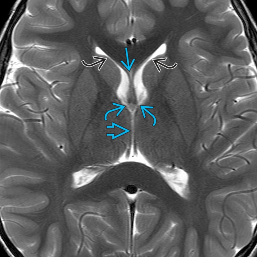 Axial T2 MR demonstrates normal anatomy at the level of the lateral ventricles. The frontal horns  of the lateral ventricle are separated by a tiny septi pellucidi . Note the foramen of Monro  connecting the lateral ventricles to the 3rd ventricle .