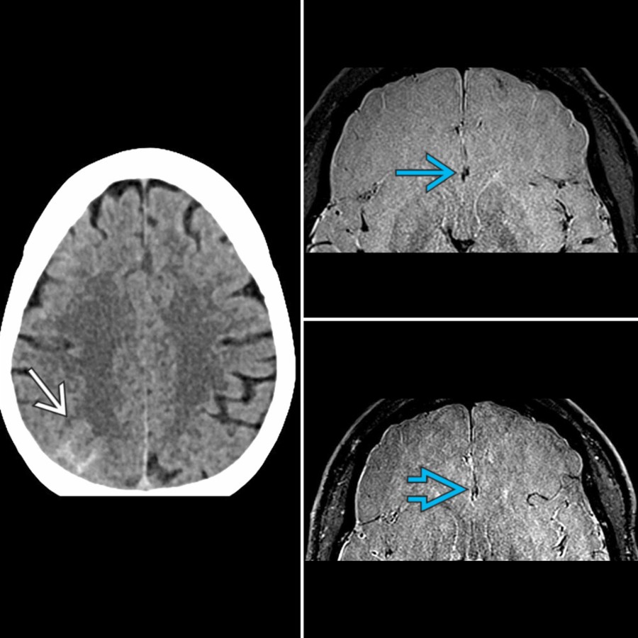 NECT in a patient with RCVS shows vertex subarachnoid hemorrhage (SAH)  . There is no associated enhancement on MR T1 DANTE SPACE pre-  or post-  contrast. Typical presentation includes a thunderclap headache; history of vasoactive drug use is also common.
