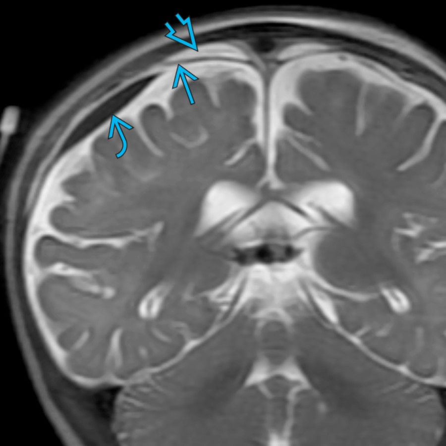 Coronal SSFSE in the same patient 6 weeks later shows a membrane  separating loculated hyperintense  & hypointense  subdural components, a finding that suggests some component of chronicity.