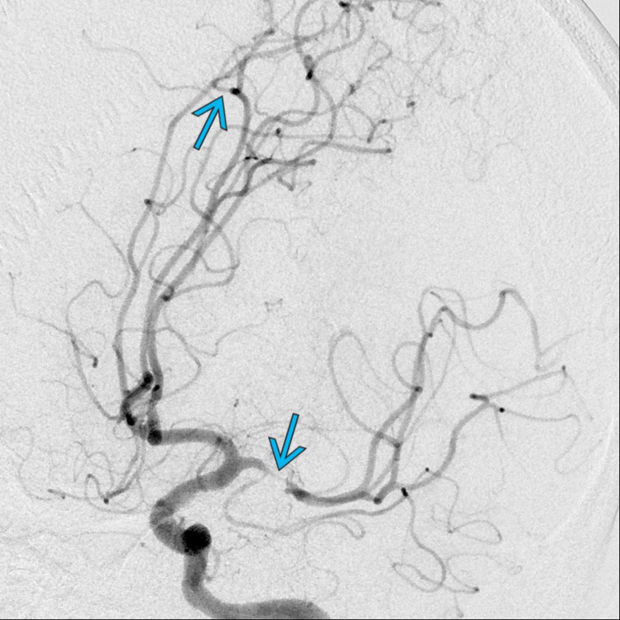 DSA shows multifocal stenoses    characteristic for atherosclerosis, the most common cause of alternating stenoses and dilatations.