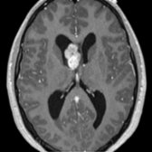 Axial T1 C+ MR shows a lobular, enhancing mass near the foramen of Monro . Subependymal giant cell astrocytomas are invariably located at this location. Other subependymal nodules and cortical tubers should be sought to confirm tuberous sclerosis.