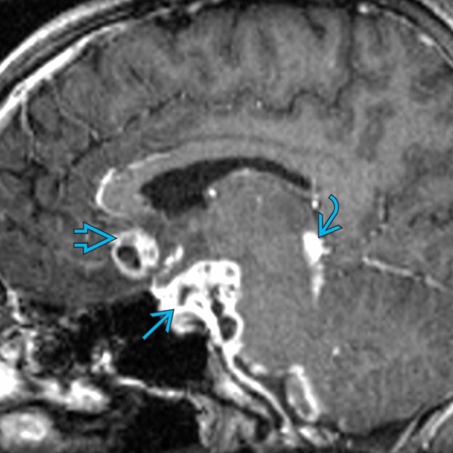 Sagittal T1 C+ MR shows abnormal enhancement in the suprasellar and prepontine cistern , inferior frontal lobe , and quadrigeminal plate cistern ,  consistent with tuberculomas. CNS tuberculosis is the most common cause of seizures from infection worldwide.
