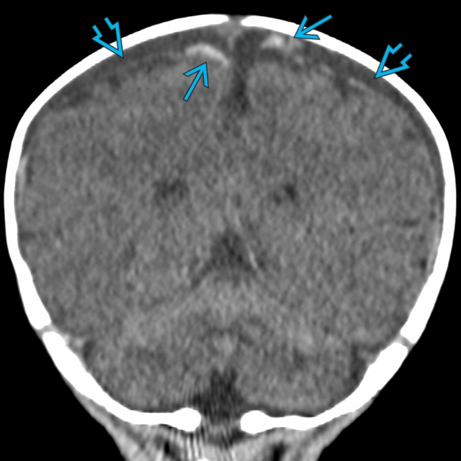 Coronal NECT in the same patient shows the bilateral subdural collections    as well as globular areas of hemorrhage    in the parasagittal regions, consistent with bridging vein injuries/avulsions.