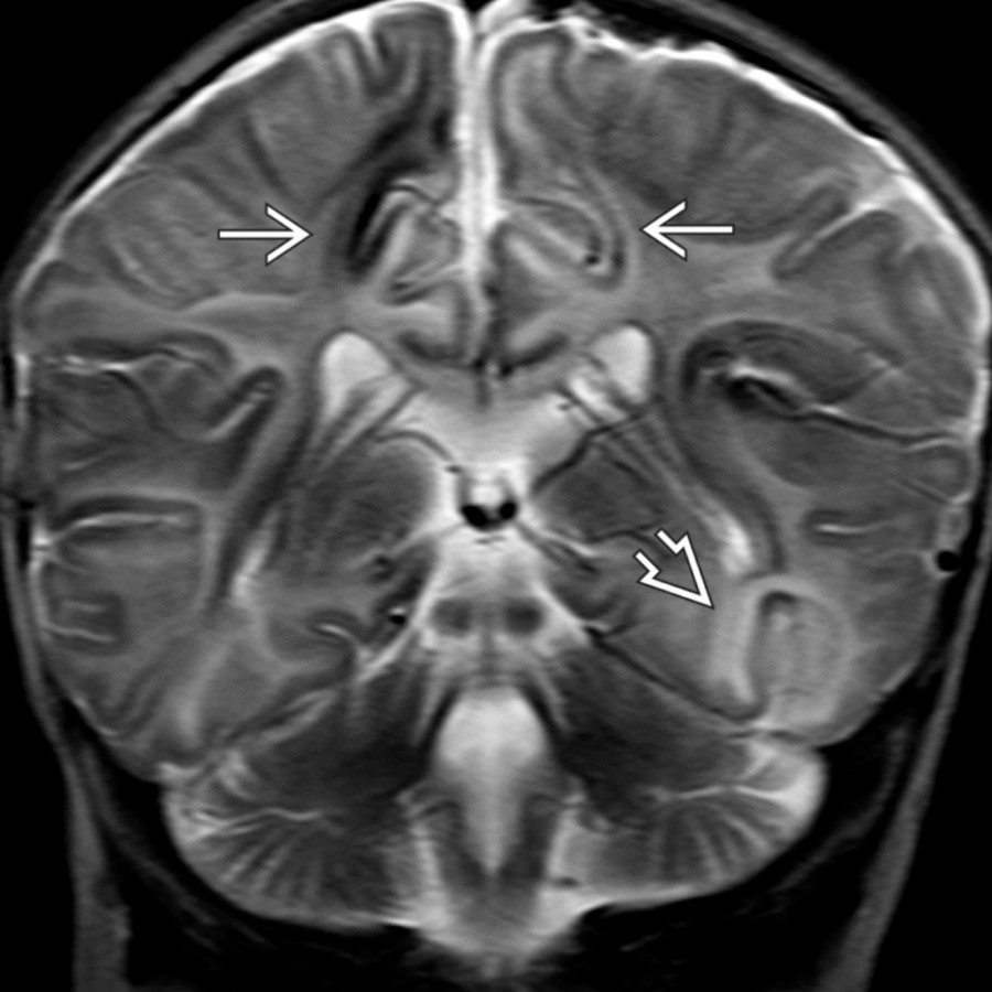 Coronal T2 MR in a 2-month-old presenting to the emergency department unresponsive shows regions of hyperintensity with loss of gray matter-white matter differentiation in the left temporal lobe  & parasagittal regions . Hypointense signal in the right parasagittal cortex reflects hemorrhagic staining.