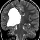 Coronal T2WI in a 6-year-old boy with left-sided spasticity and history of perinatal insult shows periventricular cystic encephalomalacia  with ex vacuo dilation of the right lateral ventricle.