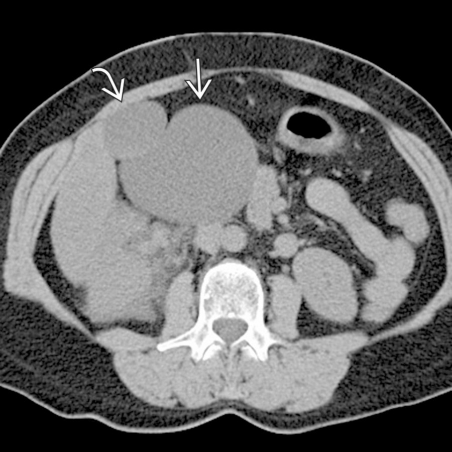 Axial NECT demonstrates a large, cystic lesion  in the right hemiabdomen immediately adjacent to the gallbladder , representing a lymphangioma. Notice the simple appearance of this lesion without any appreciable internal complexity.
