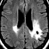 Axial FLAIR MR at the corona radiata level in a 65 year old with bilateral (left > > right) corona radiata infiltrative low-grade glioma and WaD of cerebral peduncles shows white matter (WM) hyperintense signal due to an infiltrative glioma .