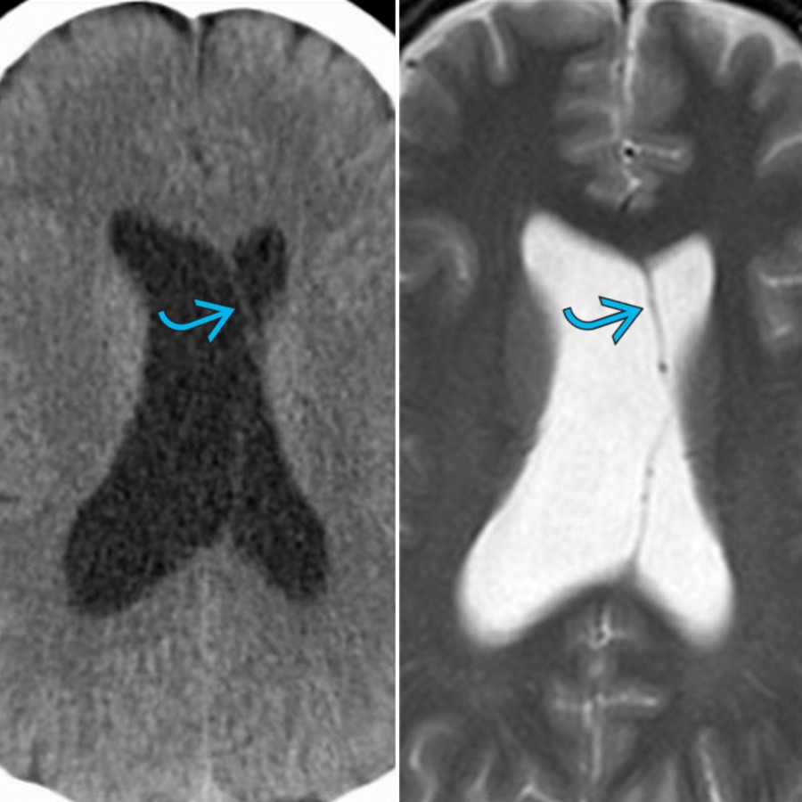 Axial NECT (L) and axial T2 MR (R) shows normal asymmetry of the lateral ventricles with the right being larger than the left. The septi pellucidi  are slightly bowed and displaced across the midline. When there is lateral ventricular asymmetry, it is important to scrutinize the region of foramen of Monro to exclude any obstructing pathology.