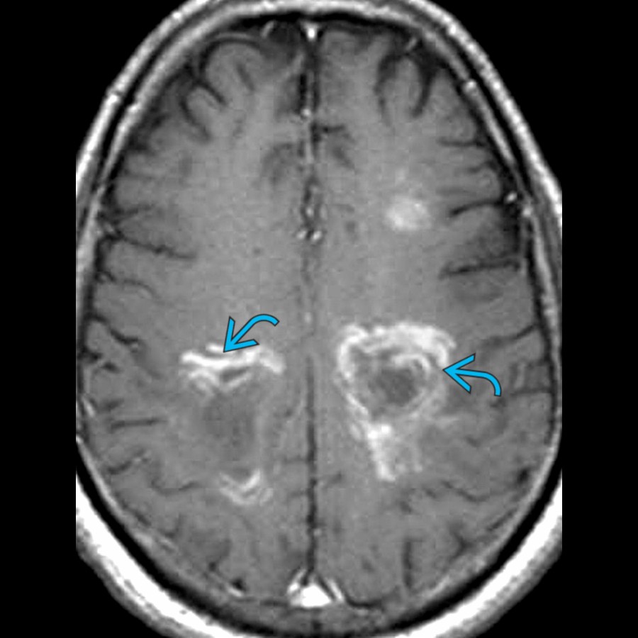 Axial T1 C+ MR demonstrates concentric laminated "onion bulb" enhancement  characteristic of acute Baló concentric sclerosis. Baló concentric sclerosis is a rare,  aggressive MS variant characterized by acute onset and rapid deterioration.