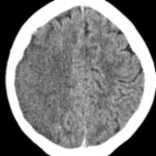 Axial NECT in a 15-year-old girl with dilated cardiomyopathy shows a large area of low attenuation in the right middle cerebral artery (MCA) territory . Note the sulcal effacement & loss of the gray matter-white matter differentiation.