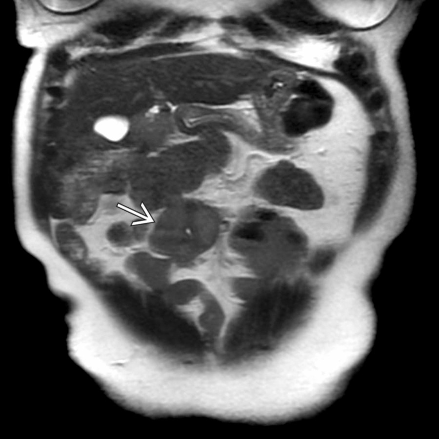 Coronal T2 HASTE MR in a patient who had undergone bowel resection roughly 6 months earlier demonstrates a well-circumscribed,  T2-hypointense mass  in very close proximity to the surgical site.