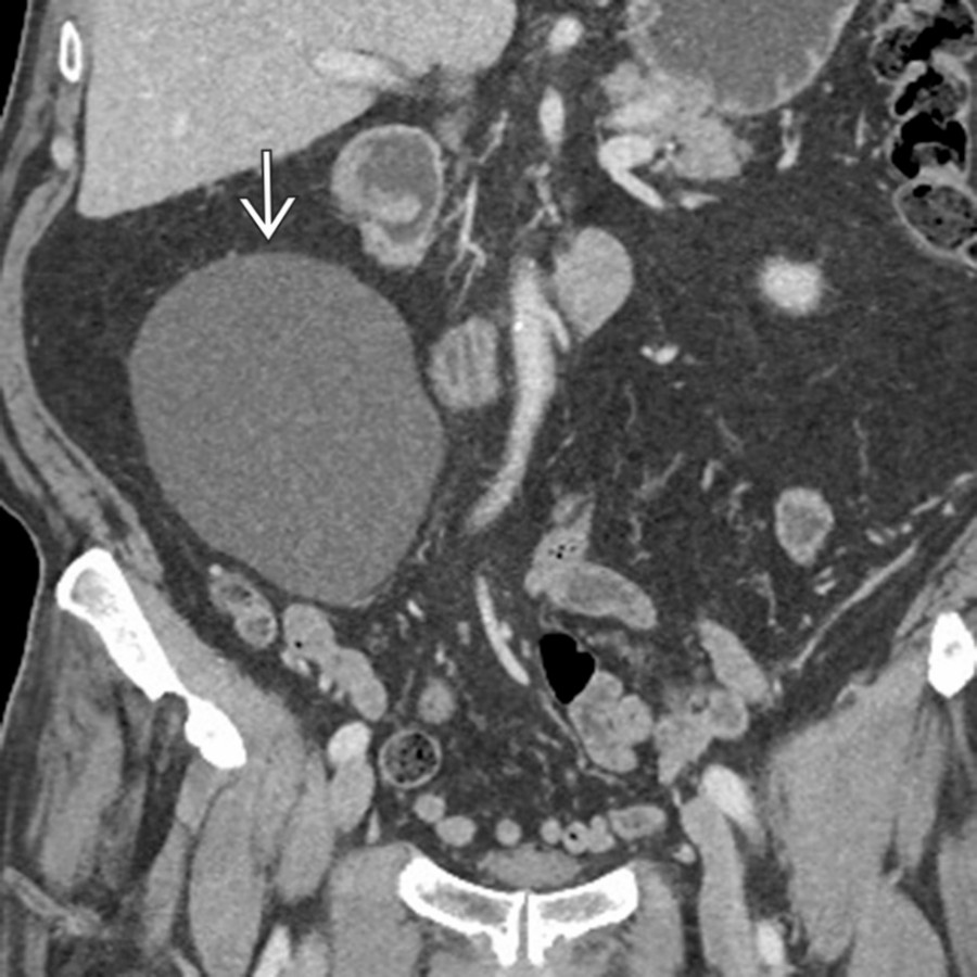 Coronal CECT demonstrates a large congenital cyst/lymphangioma    in the right hemiabdomen in a patient being imaged for a primary pancreatic lesion (not shown). These lesions are frequently incidental findings on exams performed for other reasons.