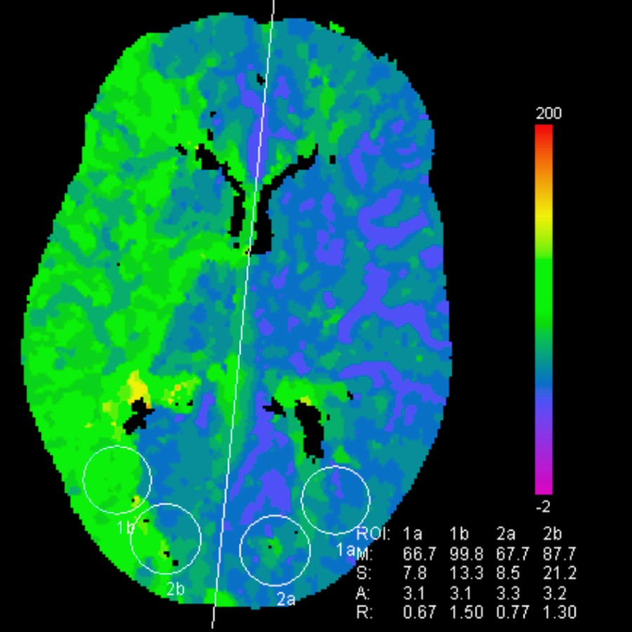 TTP in the same patient is even more striking. The abnormal side is not the right middle cerebral artery (MCA) distribution (green) but is the left side (blue) where the TTP is markedly shortened.