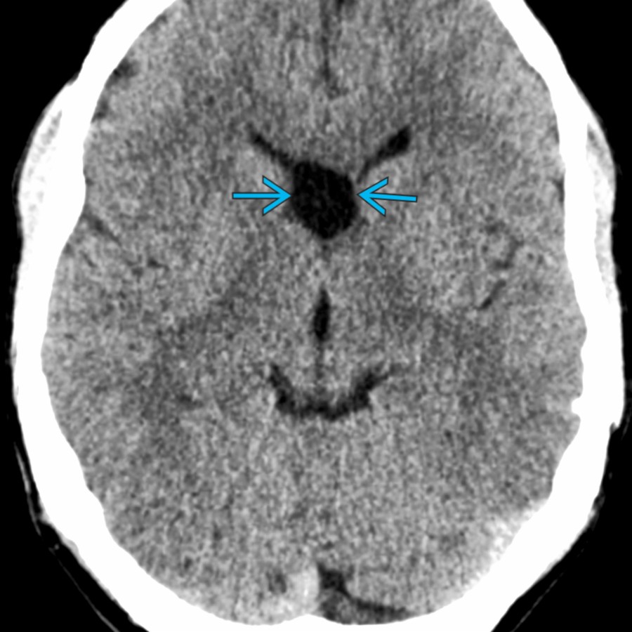 Axial NECT shows a variant of cavum septi pellucidi. Here, the CSP appears almost round .