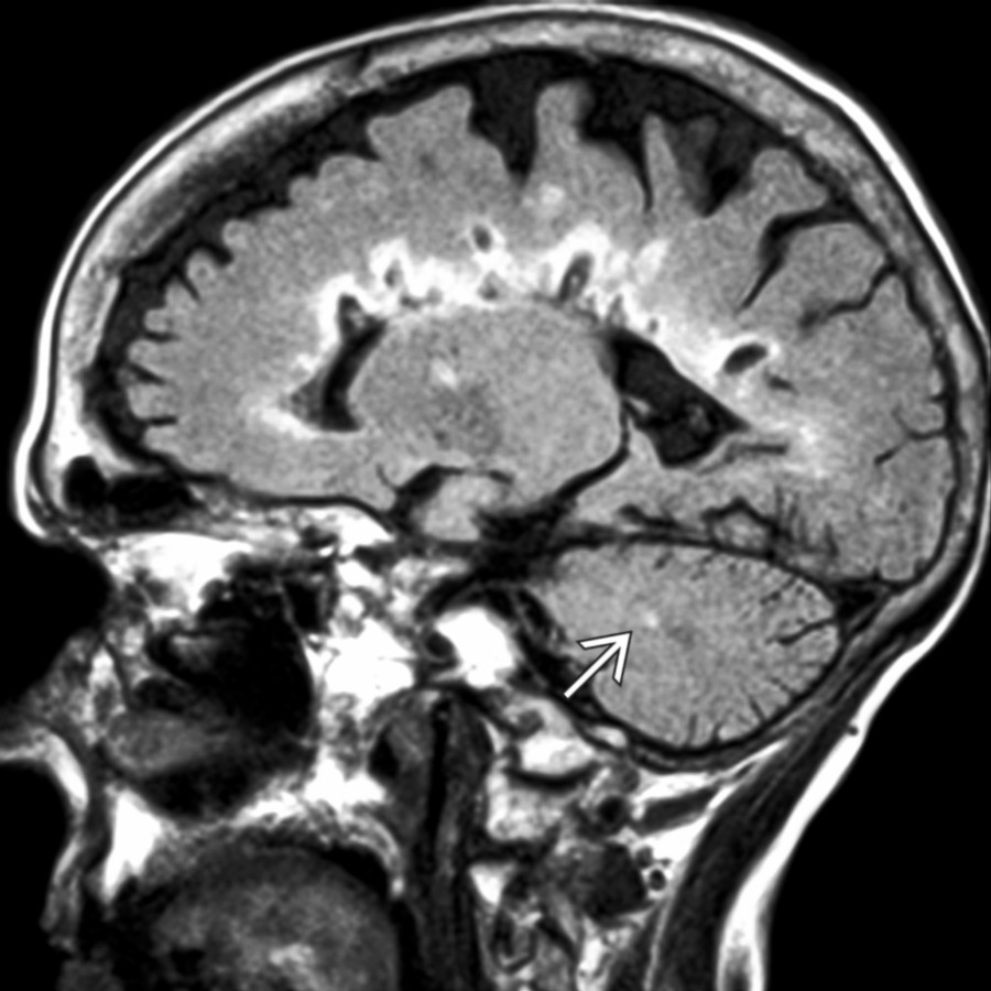 Sagittal FLAIR MR shows MS plaques with a hyperintense rim and central hypointensity (latter also hypointense on T1WI; not shown). Note the characteristic posterior fossa lesion .